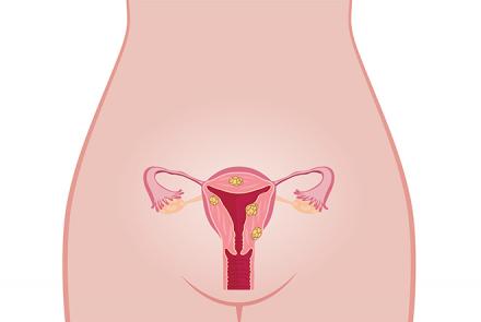 Diagram of a woman's reproductive system